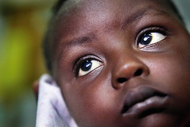 5445618486_4b3e7024a6_o A young child with bilateral cataract. TANZANIA. © CCBRT/Dieter Telemans