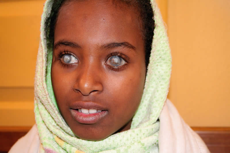 5492473278_c771ae3f53_o Corneal blindness often affects people at a young age, such as this twelve year old girl who is blind from vitamin A deficiency. She has had a penetrating corneal graft in her left eye; this has unfortunately failed. ETHIOPIA. © Lance Bellers
