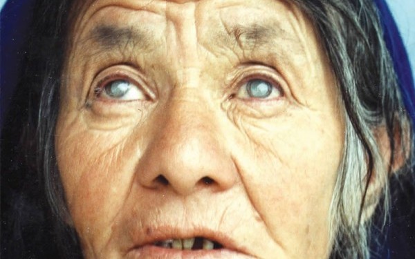 Cataract has remained the major cause of blindness worldwide for the past 20 years. AFGHANISTAN. © MM Farrahmand